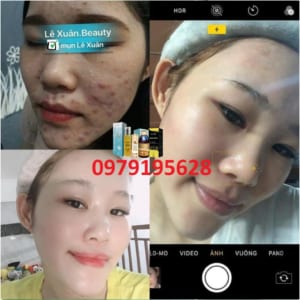 Khách dùng combo tinh chất mụn Lê Xuân