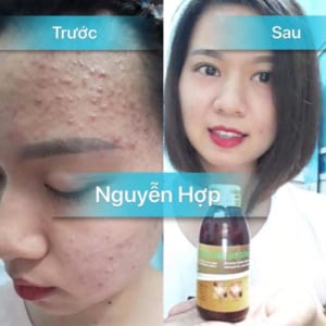 trị mụn ẩn tại nhà hiệu quả