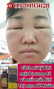 Mặt sưng đỏ và ngứa mẩn liti