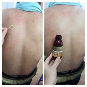 Mụn mọc ở lưng