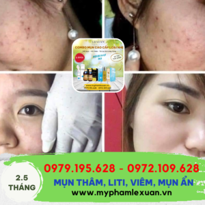 Trị mụn Lê Xuân sét bé 2 lọ mụn ẩn, mụn liti bề mặt da