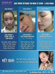 Quá trình sử dụng trị mụn Lê Xuân